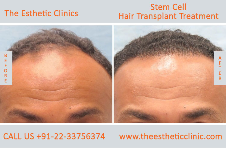 Stem Cell Hair Transplant Treatment before after photos in mumbai india (1)